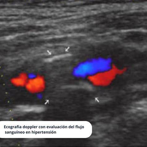Imagen de ecografía Doppler para evaluación vascular