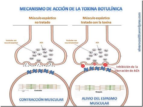Diagrama de acción de la toxina botulínica en el músculo facial