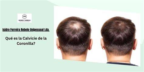 Esquema de tratamiento para calvicie en la coronilla